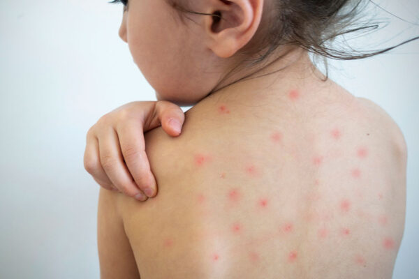 La vacunación, herramienta fundamental para prevenir el sarampión