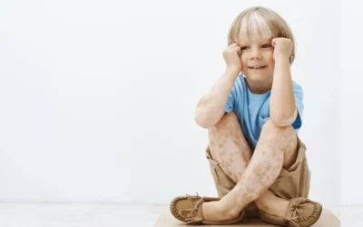 Vitiligo