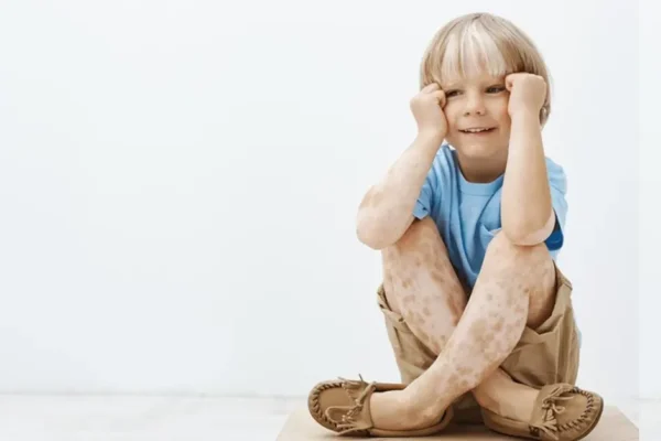 Vitiligo