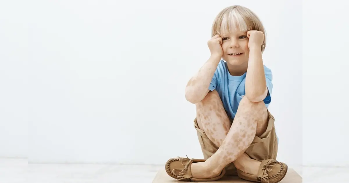 Vitiligo